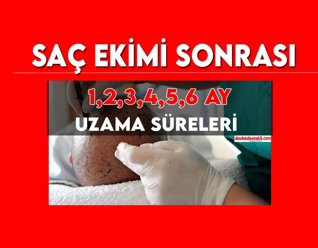 Saç Ekimi Sonrası 1-2-3-4-5-6 Ay Uzama Süreci (GÖRSELLER İLE)
