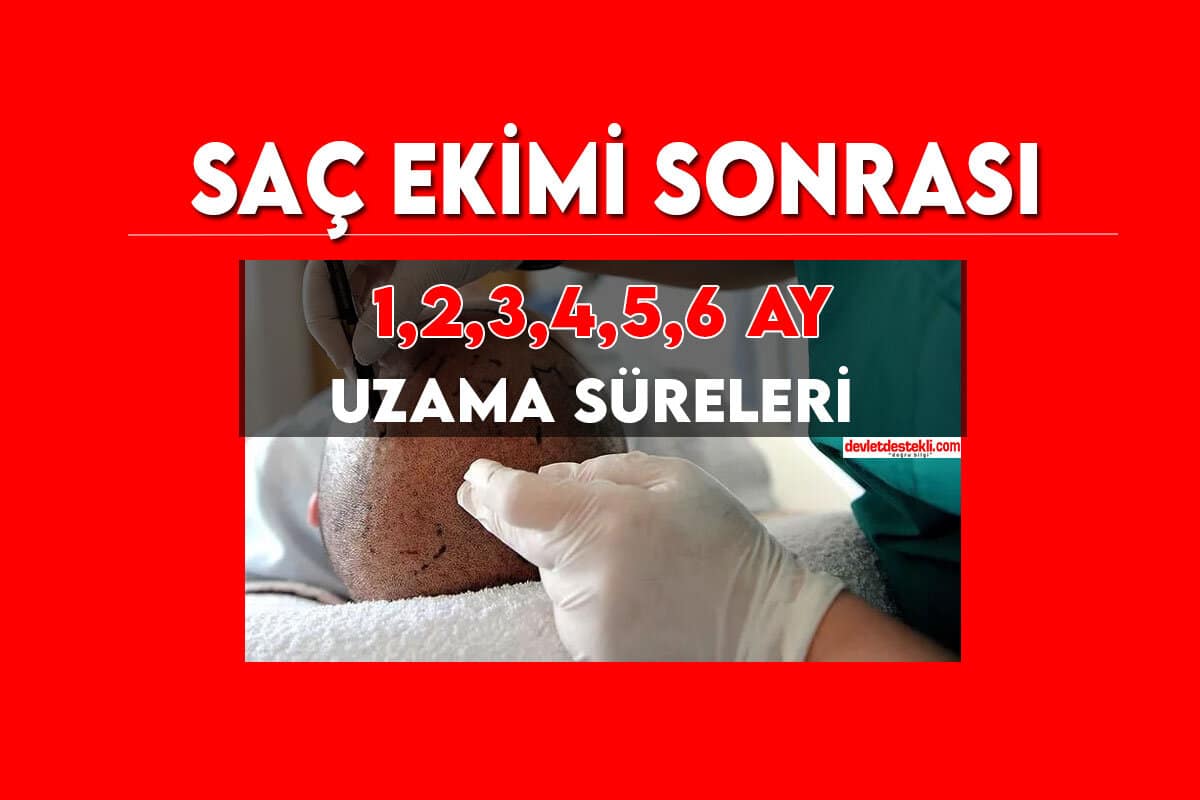 Saç Ekimi Sonrası 1-2-3-4-5-6 Ay Saç Uzama Süreci (GÖRSELLER İLE)