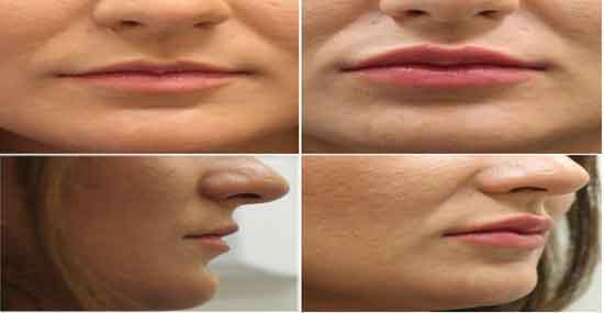 Kalıcı Dudak Dolgusu Fiyatları 2023 Tüm İller (AFRODIT, JUVEDERM)